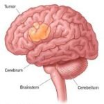 brain tumor