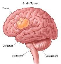 brain tumor