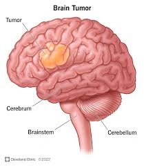 brain tumor