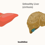 liver diseases