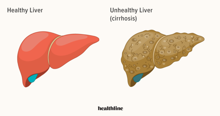 liver diseases