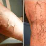 Varicose Veins | Laser treatment | Endovascular procedures |