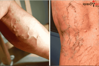 Varicose Veins | Laser treatment | Endovascular procedures |