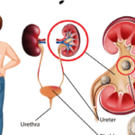 Kidney Stones | Symptoms | Painful Urination | Prevention Tips