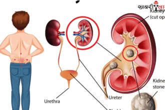 Kidney Stones | Symptoms | Painful Urination | Prevention Tips