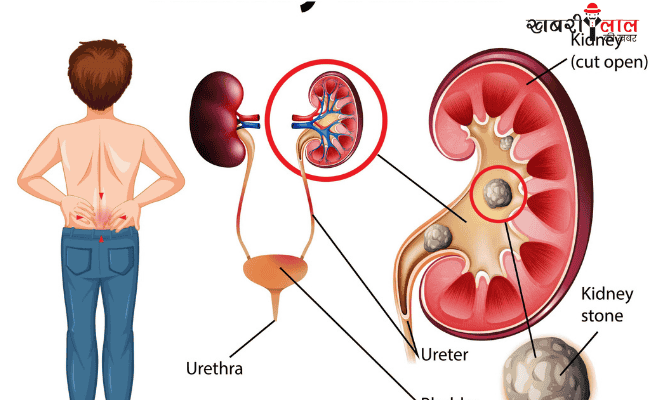 Kidney Stones | Symptoms | Painful Urination | Prevention Tips