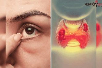 Thyroid | Eye Symptoms | Hyperthyroidism | Hypothyroidism