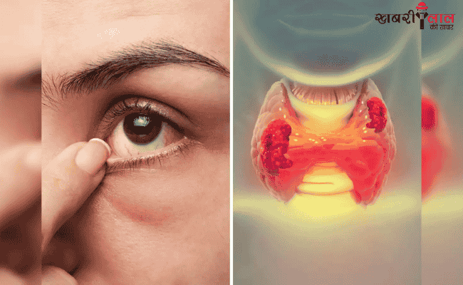 Thyroid | Eye Symptoms | Hyperthyroidism | Hypothyroidism